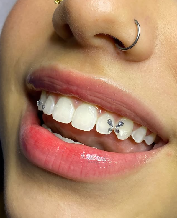 Aplicação de Piercing Dental